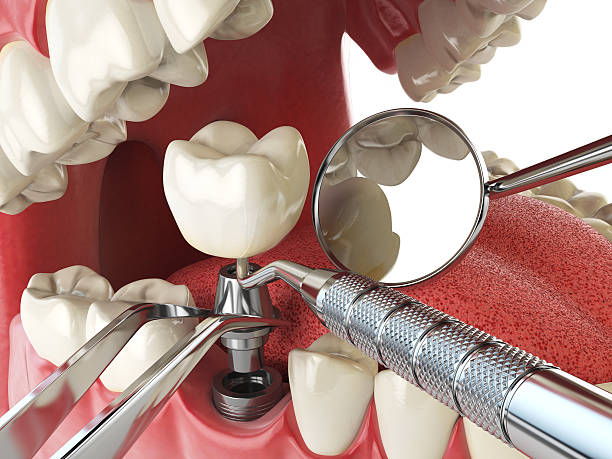 Best Emergency Treatment for Dental Infections or Abscesses in Ware Shoals, SC